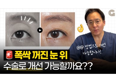 눈이 꺼지니까 진짜 인상이 확 늙어보여요
