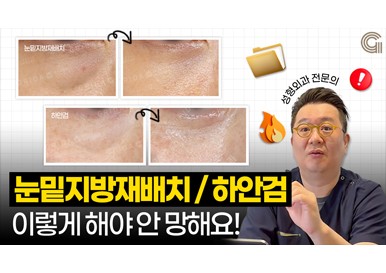 눈밑지방재배치VS하안검 ! 성형외과 전문의가 보여주는 추천 대상✅