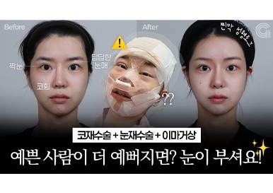 예쁜 사람이 더 예뻐지면? 눈이 부셔요! (눈재수술+코재수술+이마거상)