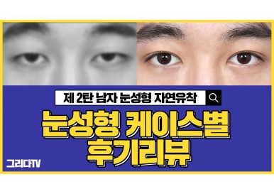 눈성형 케이스별 전후 후기 리뷰! _제2탄 남자 눈 성형 자연유착 (남자쌍수전후,남자 자연유착쌍꺼풀)