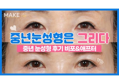 하안검수술후기 눈밑지방재배치후기 중년눈성형 전후후기 영상