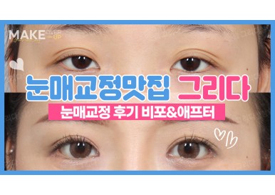 눈매교정전후 리얼후기! 