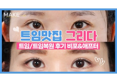 트임 / 앞트임복원 / 트임재수술 전후 후기! 앞트임 윗트임 뒤트임 밑트임 맛집 그리다