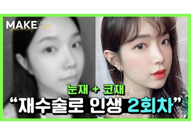 한수아님 리얼셀피 눈재수술 + 코재수술