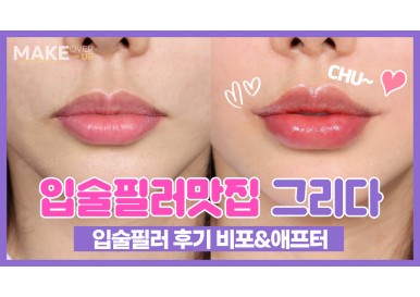 입술필러 전후 후기! 지금 바로 확인하세요 / 그리다성형외과