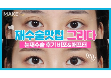 눈재수술 전후사진 후기