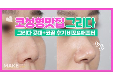 코성형후기 전후사진 