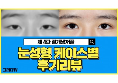 눈성형 케이스별 전후 후기 리뷰 _제4탄 절개쌍꺼풀 (절개쌍꺼풀 재수술 ,눈재수술 절개)