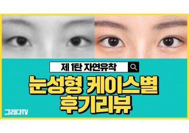 눈성형 케이스별 전후 후기 리뷰! _제1탄 자연유착 쌍꺼풀수술 (비절개쌍꺼풀,자연유착쌍수)