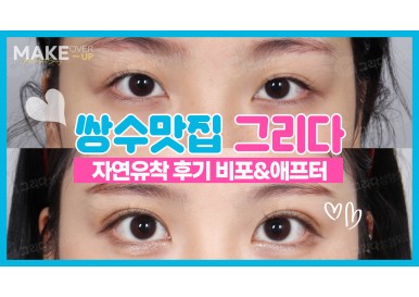 눈성형 전후 사진 
