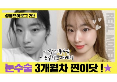 [성형 브이로그] 황지수님 2편