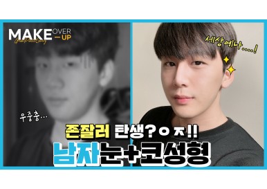 [메이크오버업] 남자눈매교정, 코성형 셀카경과