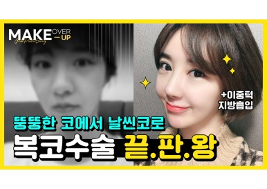 [메이크오버업] 복코수술,이중턱지방흡입 셀카경과