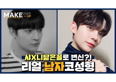 [메이크오버업] 남자코성형전후 (매부리코수술)